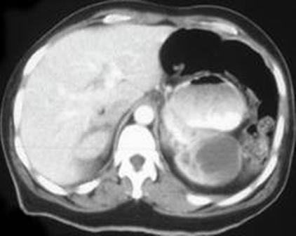 renal abscess